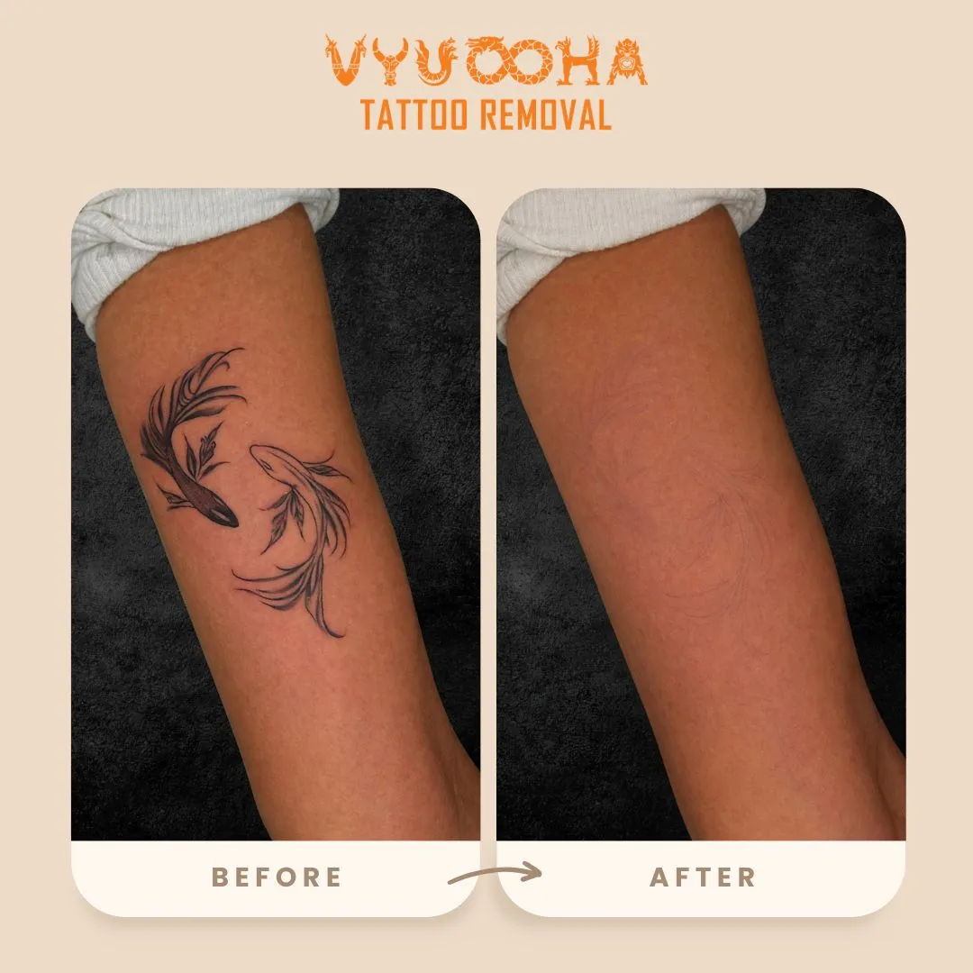 Tattoo Removal - Vyuooha Tattoo Service